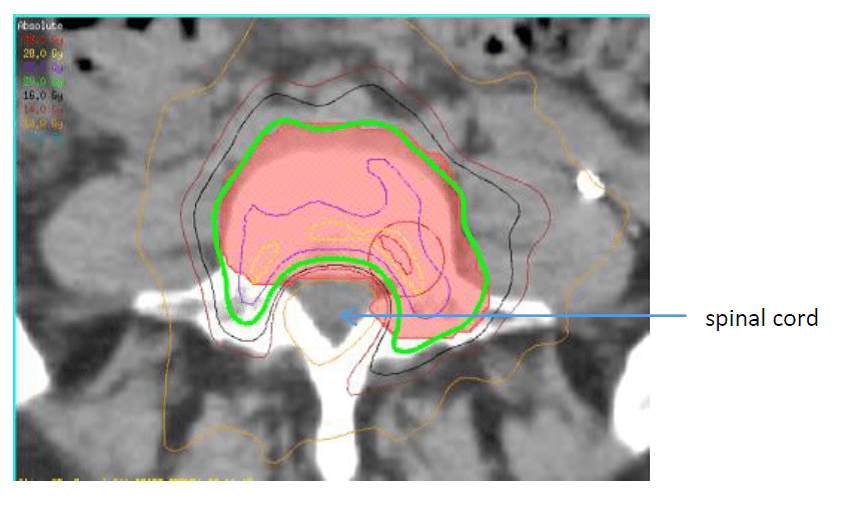 MRI画像は、脊椎骨（背骨）の転移（二次がん）に対する放射線治療計画について示したものです。 緑色の線で示した高線量が、赤色の斜線で示した治療対象のがんの骨を取り囲んでいます。 
